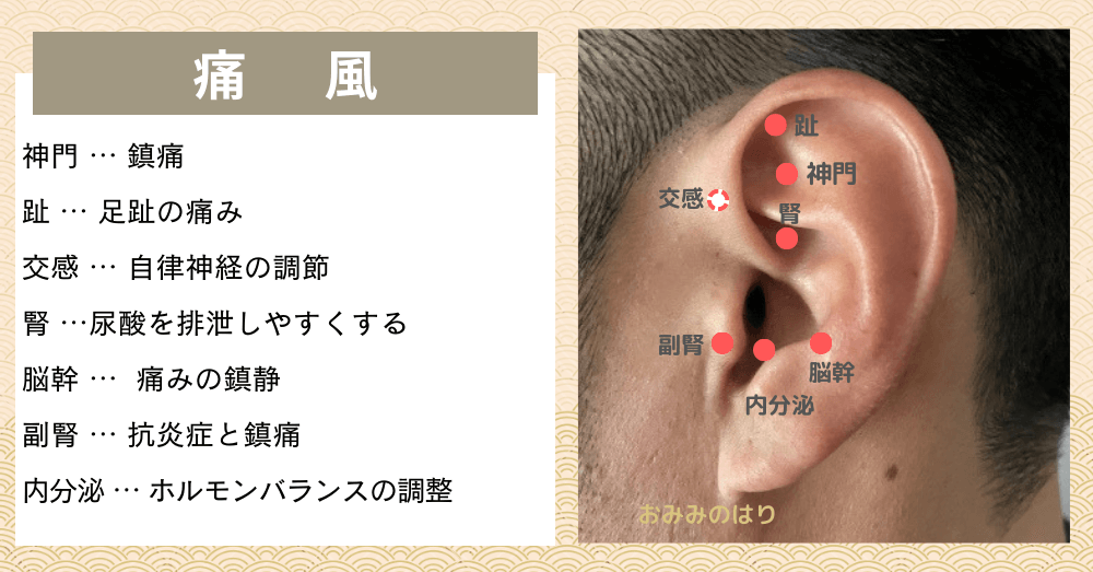 痛風が耳つぼ耳鍼治療で改善