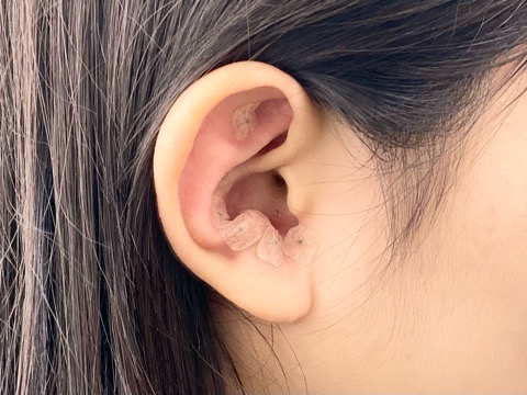 王不留行を使用した耳鍼の施術例
