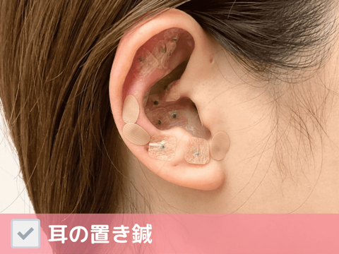耳の置き鍼
