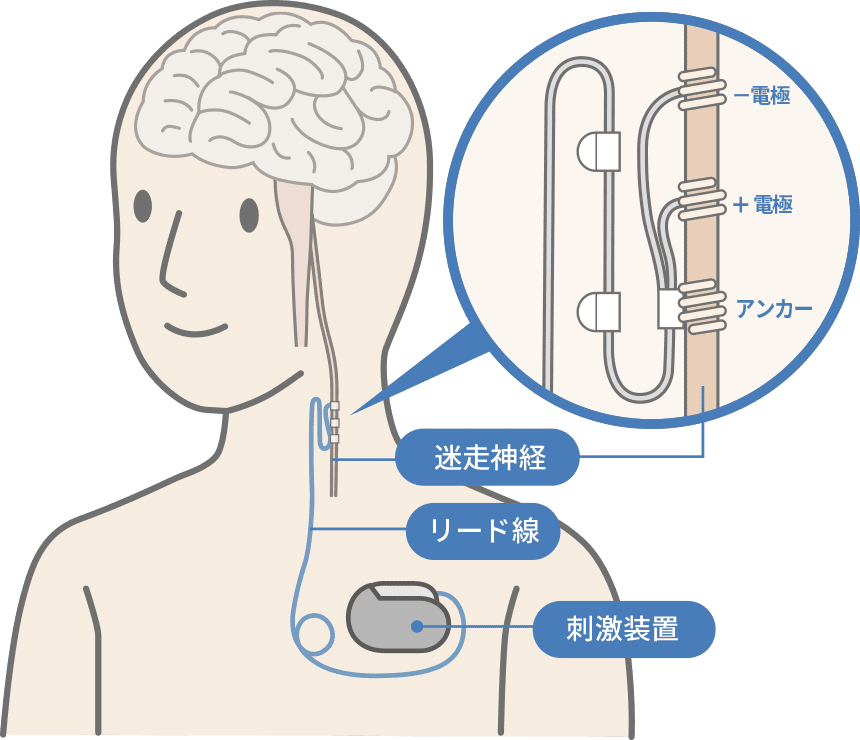迷走神経刺激療法