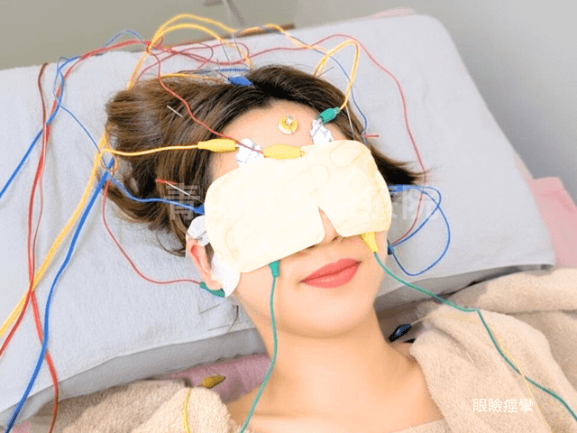 眼瞼痙攣の鍼灸